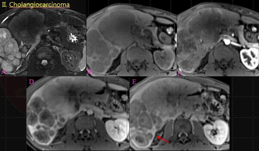 Fig. 10: A patient with pathologically confirmed cholangiocarcinoma at Segment 6 subcapsular portion: A. High SI on T2WI B. Low SI on pre-enhanced T1WI C. Early arterial subtle enhancement pattern D.