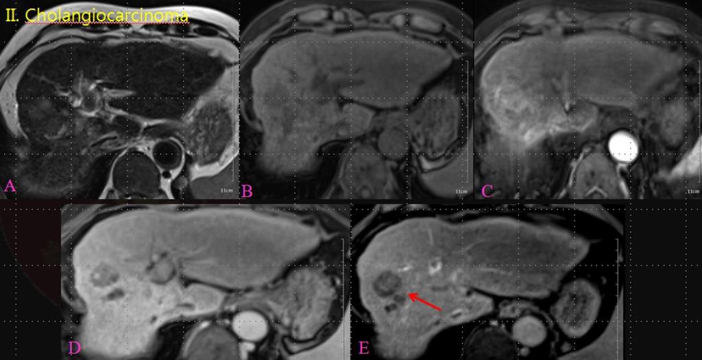 Fig. 12: A patient with pathologically confirmed cholangiocarcinoma: A.