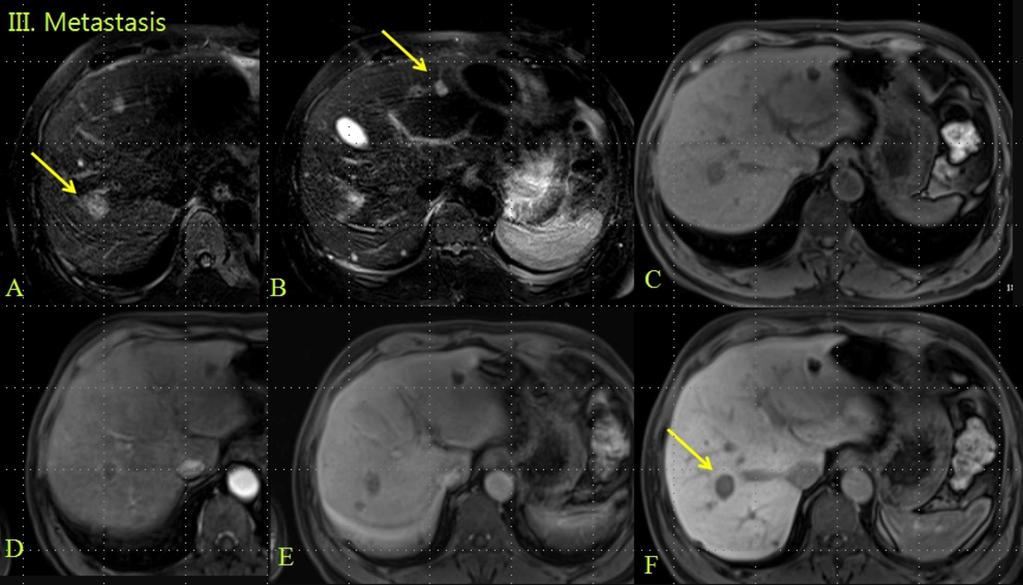 Fig. 13: (ABOVE) A colon-cancer patient with liver metastasis using Primovist shows ring enhancement in arterial phase & hypointense compared to well-enhancing surrounding liver, with paradoxical