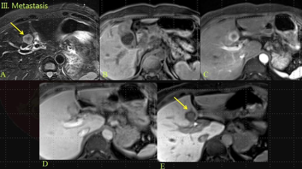 Fig. 15: Suspicious single metastatic lesion on segment 4 from GB cancer patient: A. Single High SI lesions on T2WI B.