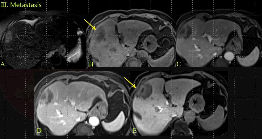 Wash-out pattern on equilibrium phase (2min) E. Reversed target appearance on hepatobiliary phase (20 min) Fig.