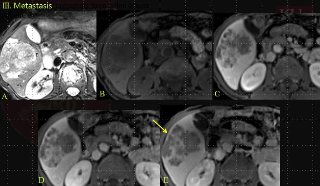 pattern D. Centripetal enhancement pattern on equilibrium phase (2min) E. Reversed target appearance on hepatobiliary phase (20 min) Fig.