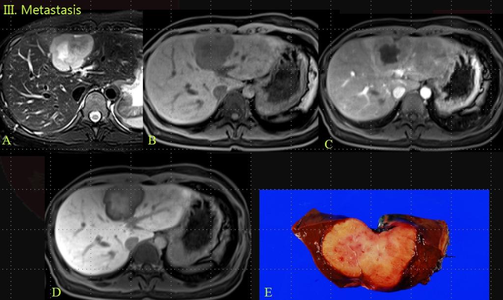 Fig. 18: A patient with breast cancer metastasis, confluent