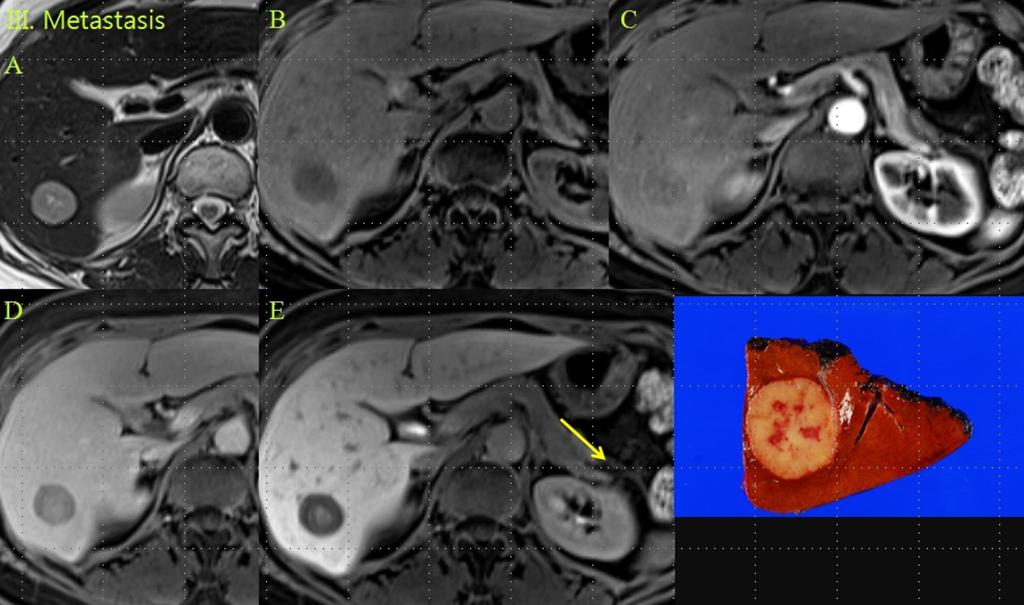 Fig. 19: A patient with breast cancer metastasis, Miliary: A. Heterogeneous high SI on T2WI B. Low SI on pre-enhanced T1WI C. Early arterial tumor enhancement in periphery D.