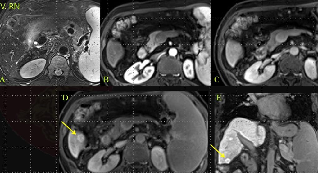 23: A patient with suspicious regenerative nodule seen only on hepatobiliary phase on Gd-EOB-DTPA enhance MR & no