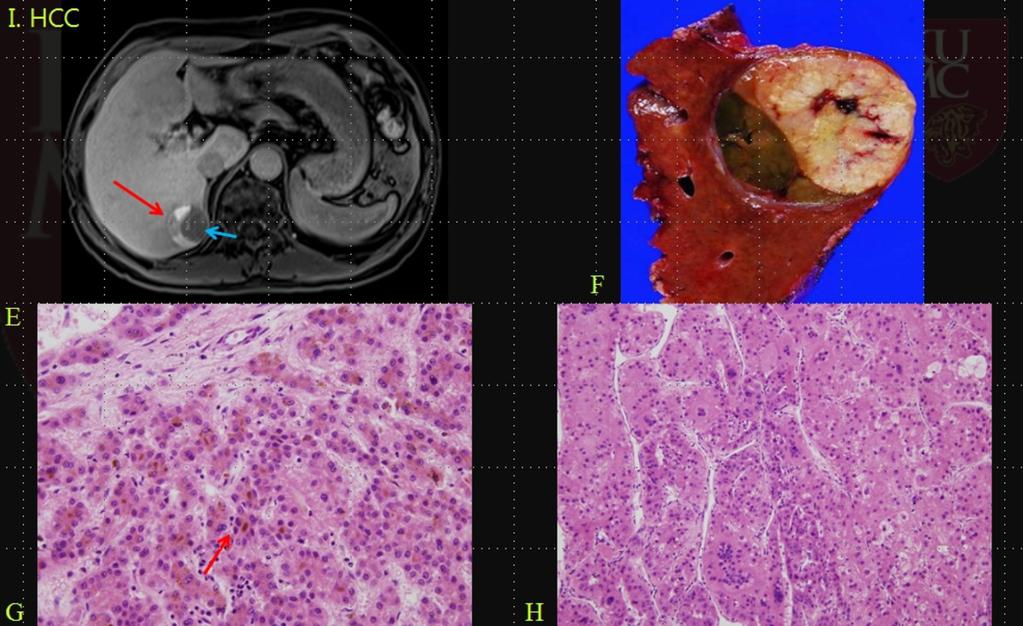 Fig. 3: A 70-year old man with pathologically proven G1 HCC in liver segment 7: (AE) The lesion shows low SI on pre-contrast T1 weighted images (A), enhancement in the lateral portion (red arrow) and
