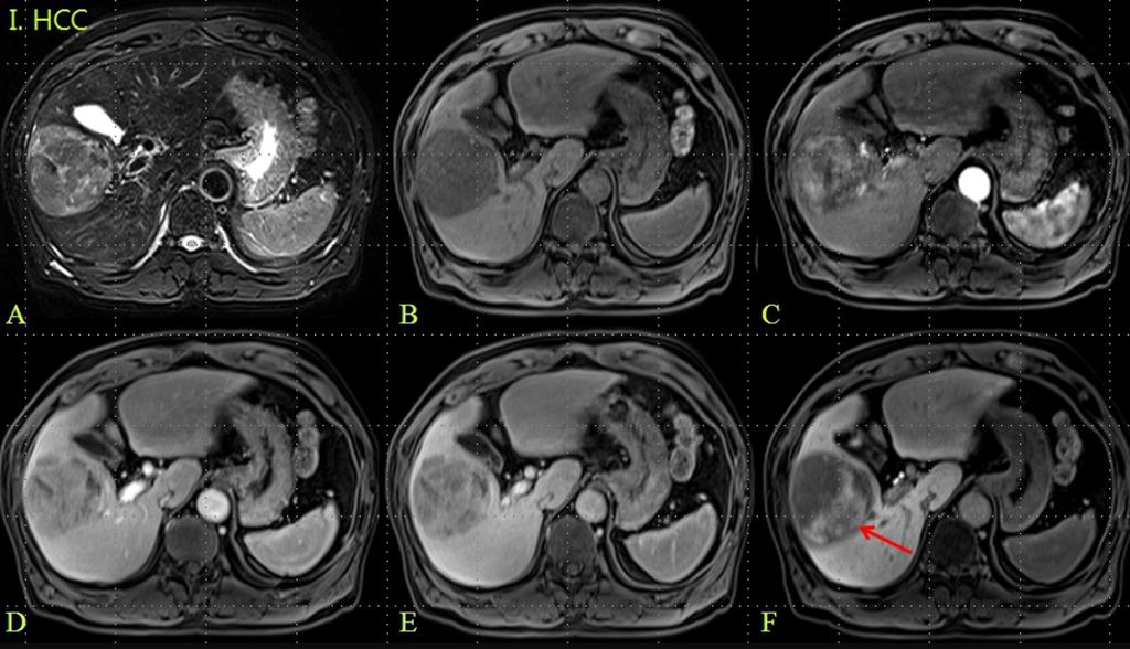 Fig. 5: A 54-year-old man pathologically proven G1 HCC in liver segment 5: MRI showed high SI mass in Segment 5 of the liver on T2WI (A), low SI on pre-enhanced T1WI (B).