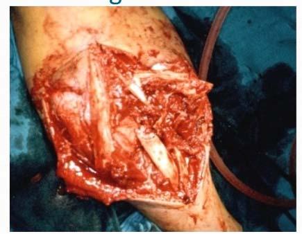 Debridement and Irrigation As soon as possible Scrub and brush wound dirt