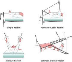 Skeletal Stabilisation Evaluate vascular status, limb salvage, debridement and irrigation Stabilize