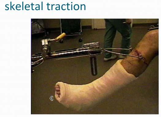 Method Skeletal stabilisation