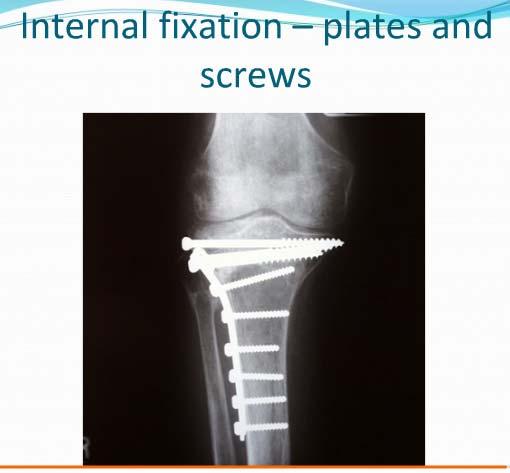 Internal Fixation Plate and screw
