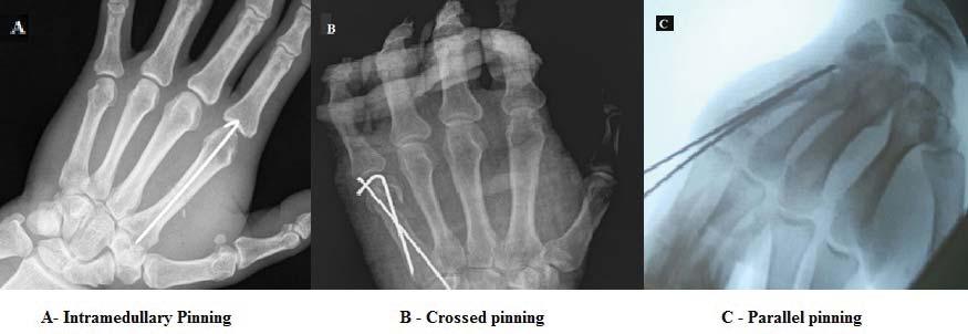 Comparison of Osteosynthesis Using Plates and Screws Versus Kirschner Wire Fixation for Unstable Metacarpal Fractures INTRODUCTION Hand surgery is considered to be the biggest challenge for every