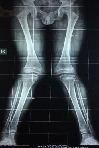 Patwardhan et al. [18] studied 37 knee joints in 19 childrens. Age group was between 2 year 4 months to 11 year 2 months. In our study, we included children of age between 3 years to 13 year 5 months.