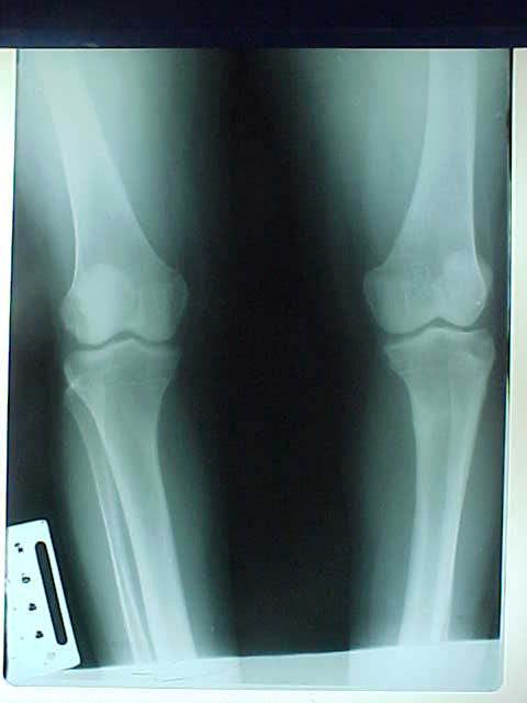 Hossam Kandil MD A B C D (A) 3% )&% (B) Level of dome-shaped osteatomy just distal to