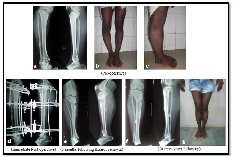 CASE PRESENTATIONS Present study was done at Department of Orthopaedics, Sri Ramachandra Medical College and Research Institute, Sri Ramachandra University, Chennai, India during January 2015 to