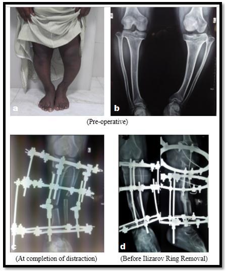 Figure 2: Case of Achondroplasia for which left tibia vara for which corrective