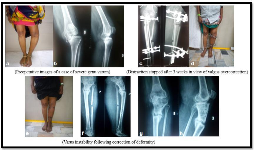 Figure 3: Case of severe genu varum from osteoarthritis considered to be a failure as