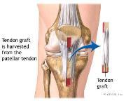 ACL sprain management ACL INJURY EPIDEMIOLOGY
