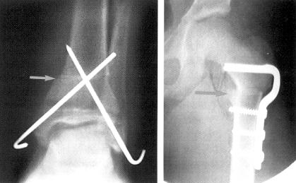 Operative treatment Torsional deformity Femur -- rotational osteotomy - level: intertrochanter, subtrochanter,