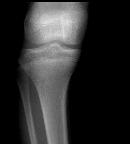 Lateral Hemiepiphysiodesis R= 5 cm Bone age = 12 yr Growth remaining in proximal tibia = 1.
