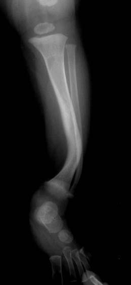 Prevention of Fracture Long leg brace :
