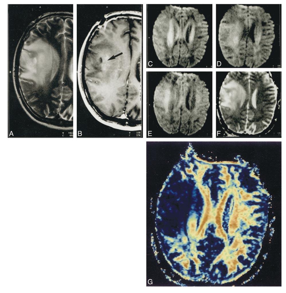 97 STADNIK AJNR:, May FIG. Images from the case of a 34-year-old man with a large grade II astrocytoma in the inferior frontal and parietal area.