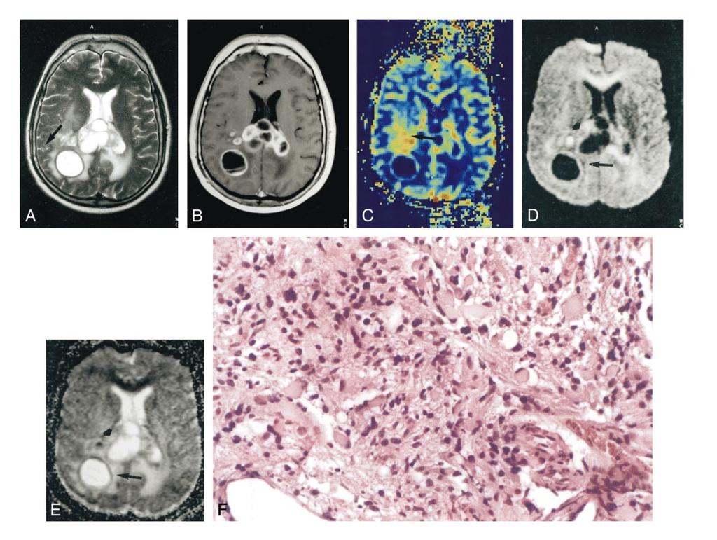 AJNR:, May INTRACEREBRAL MASSES 973 FIG. Images from the case of a 5-year-old man with a large glioblastoma.