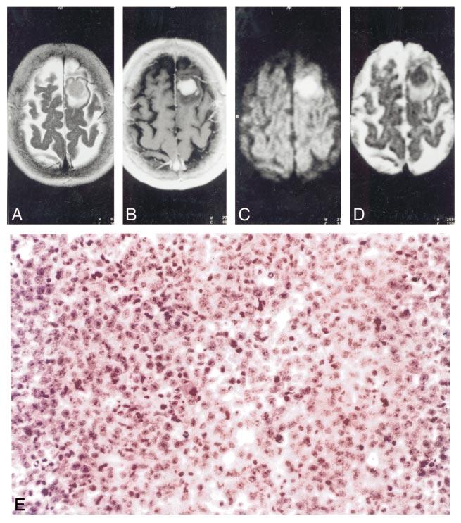 974 STADNIK AJNR:, May FIG 3. Images from the case of a 7- year-old woman with a cerebral lymphoma. A, Fast T-weighted spin-echo image shows lesion to be moderately hyperintense.