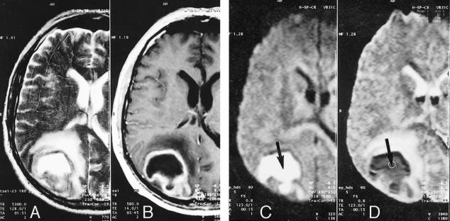 AJNR:, May INTRACEREBRAL MASSES 975 FIG 4. Images from the case of a 7- year-old man with a streptococcus abscess, recent history of acute dizziness, and focal seizures.