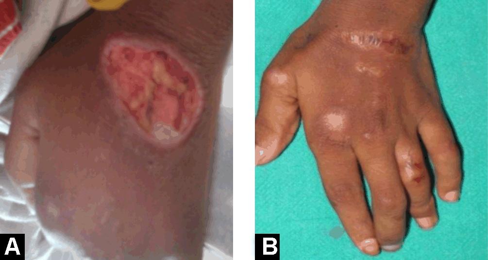 Damor et al. 47 ulceration and evaluation of associated secondary disease. We report a rare case of pyoderma gangrenosum with multiple ulcers associated with Crohn s disease in a 14 year old child.
