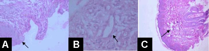 Damor et al. 48 Figure 3: (A) Showing H/E staining of tissue acquired through biopsy at the ulcer site.