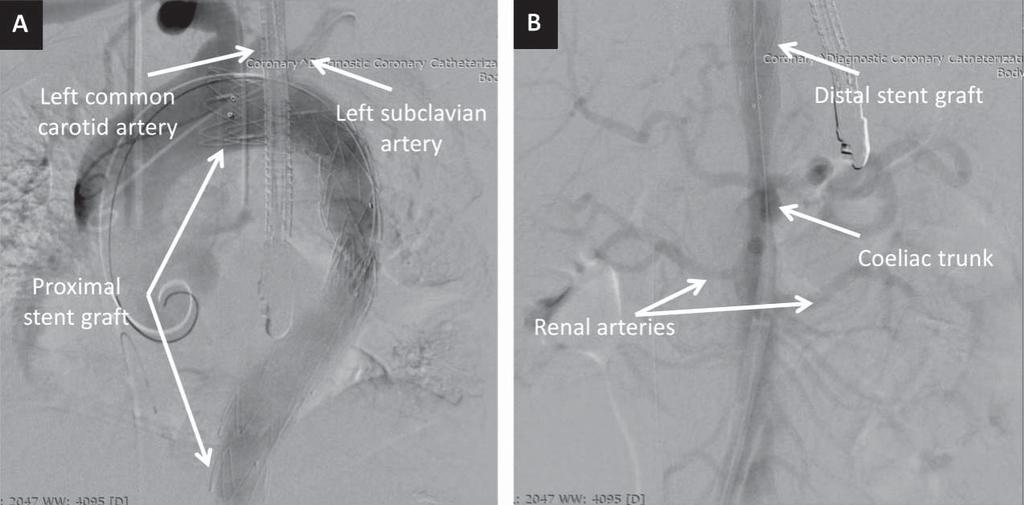 Figure 2. Digital subtraction angiography images in postero-anterior view showing the proximal (A) and the distal (B) stent grafts.