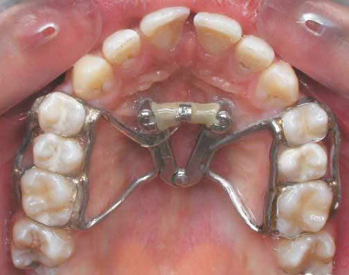 The mandibular device for the midline distraction osteogenesis (in place) Fig. 6,7 (Medicon, Germany).