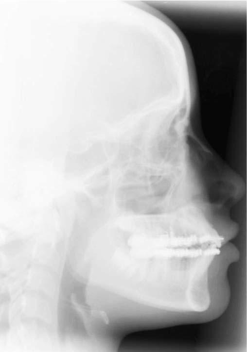 osteotomy the mandibular halves were separated completely.