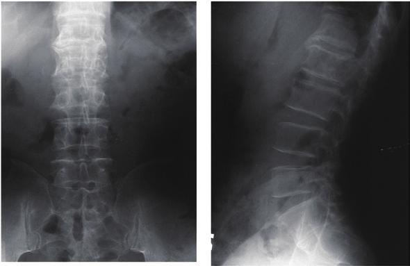 198 Norimitsu Wakao et al. CASE REPORT A 61-year-old male presented with low back and right lower-extremity pain. He gradually developed low back pain of no obvious origin.