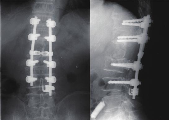 3 After first operation (total en bloc spondylectomy), fusion area was T12-L4 with instruments. An iliac bone transplant was performed to provide an anterior strut graft (Fig. 3).