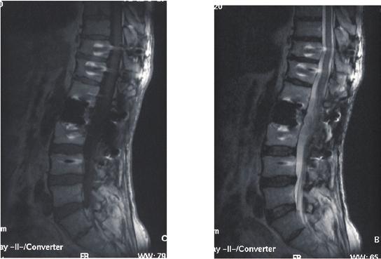 TOTAL EN BLOC SPONDYLECTOMY FOR L2 CHORDOMA 201 a b c Fig. 7 CT images 10 years after second operation. Transplanted mesh cage implant with fibula was fused.