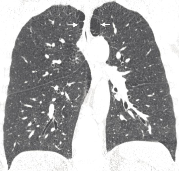 92 CT Findings in Nonobstructed Spirometric Smokers Table 2.