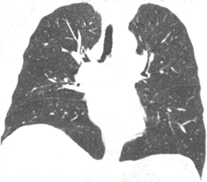 93 CT Findings in Nonobstructed Spirometric Smokers Figure 3. Right Diaphragmatic Elevation in a GOLDU Participant.