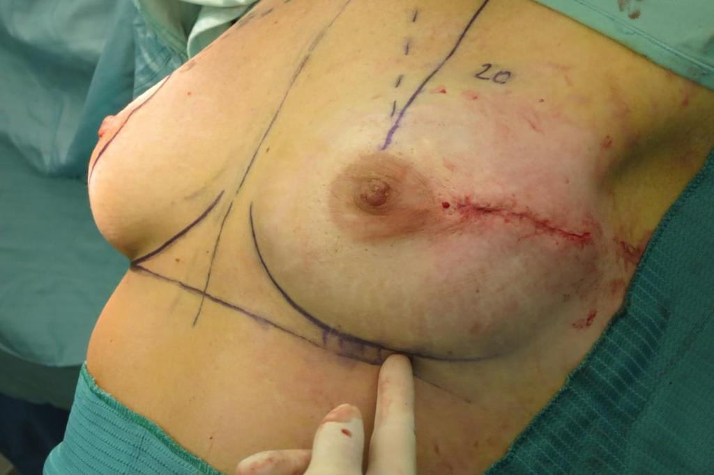 SKIN INCISION Upper-outer radial incision.