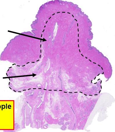 Nipple-Areola Complex Management Ductal tissue within nipple