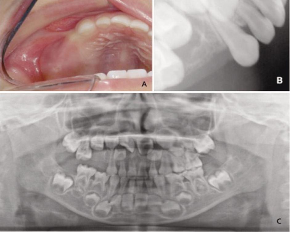 Ⅱ. Case Report A 4-year-old boy was referred to the Department of Pediatric Dentistry at the Kyung Hee Dental Hospital, Seoul, Republic of Korea, by his family dentist for evaluation of unerupted