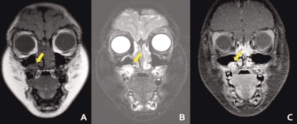 Magnetic Resonance Imaging (MRI) was taken to differentiate the lesion with the odontogenic cyst. The T1- weighted image (WI) of the MRI showed medium signal intensity, which confirmed the CBCT (Fig.