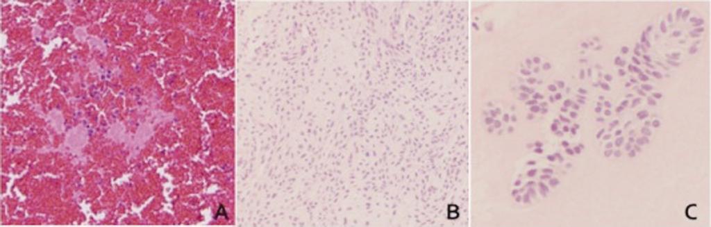 Fig. 5. (A) A cytologic smear showed no malignant cells.
