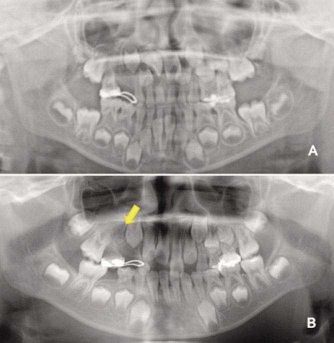 Panoramic view (A) 18 months, (B) 36 months after the operation. The radiographic image around the root of the right primary second molar revealed the generation of the tooth germ (arrow). Ⅲ.