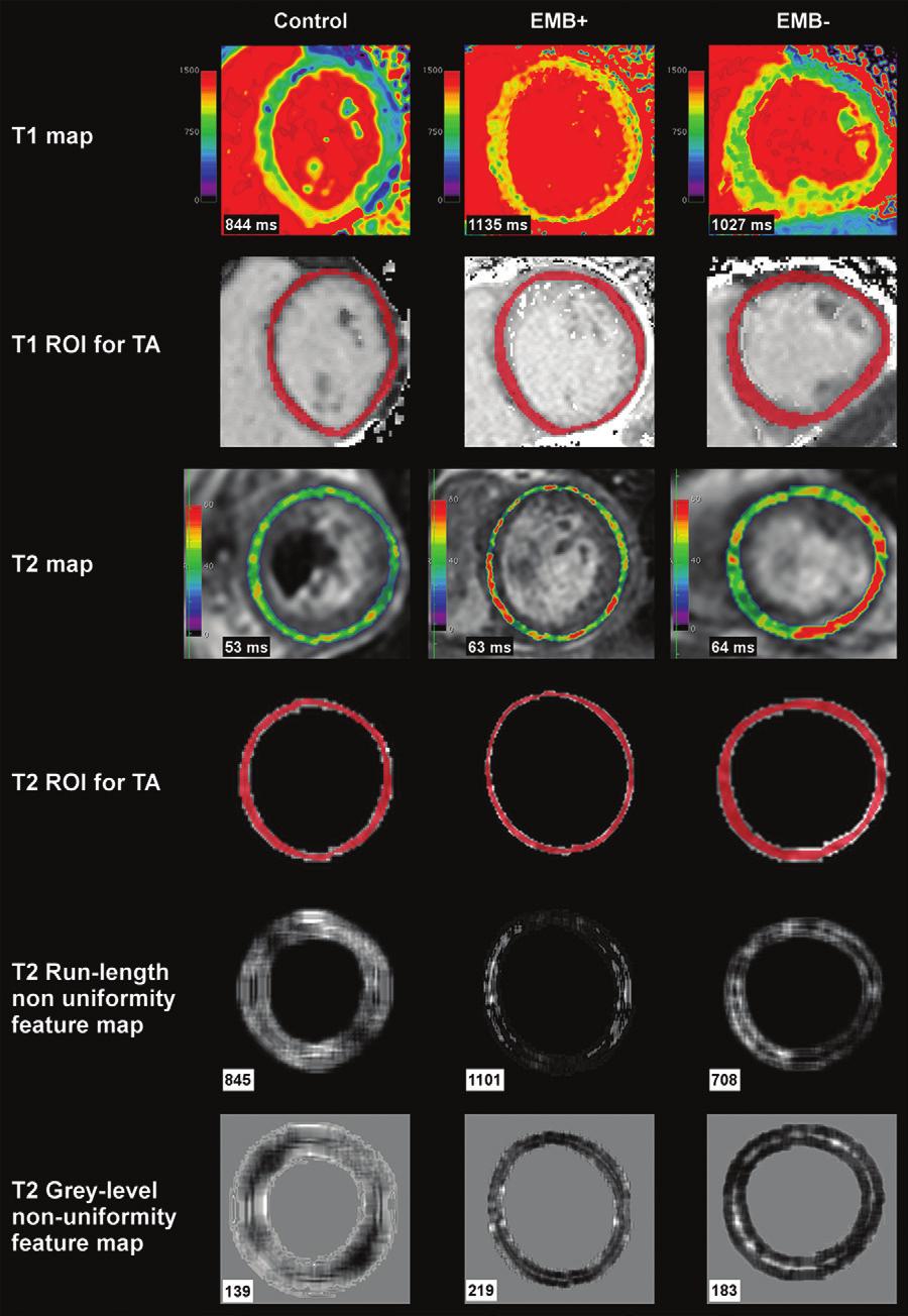 Cardiac MRI Texture Analysis of T1 and T2 Maps in Infarctlike Acute Myocarditis Figure 2: Image shows cardiac MRI findings in one exemplary healthy control participant, one participant with positive