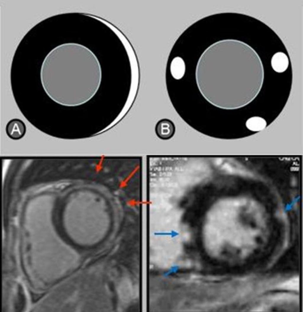 Fig. 10: Focal and multifocal patterns of late gadolinium enhancement in myocarditis : focal hypersignals