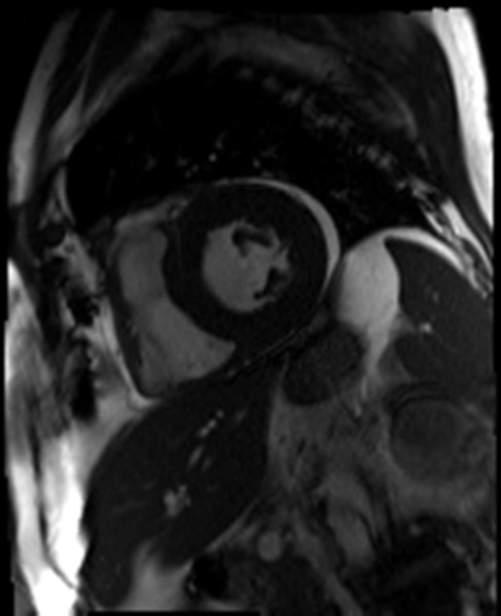 Fig. 2: Short-axis view of a patient with myocarditis showing pericardial effusion