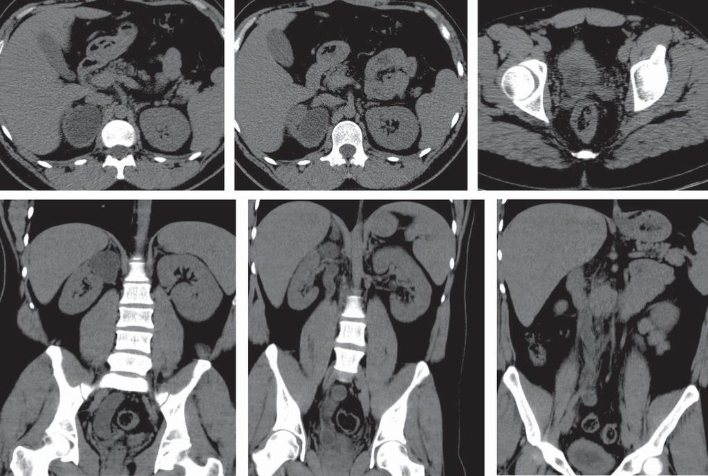 The Management of Congenital Ureteral Duplication Anomalies Complications - Case Presentation Figure 1-5. Preoperative CT scans. the ureteral orifice due to the large dimensions of the ureterocele.