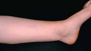 Clinicl ppernce of two treted legs one yer postopertively with slight limp. In two ptients minor swelling of the nkle region ws noted. All nkle joints were moile within functionl limits.